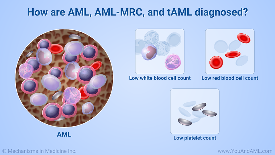 How are AML, AML-MRC, and tAML diagnosed?