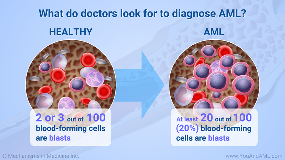 What do doctors look for to diagnose AML?