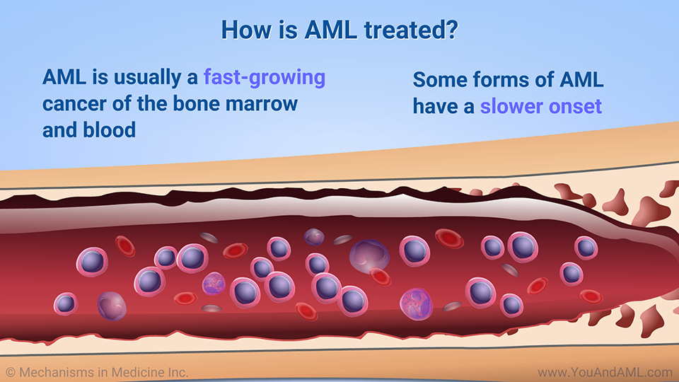 How is AML treated? 