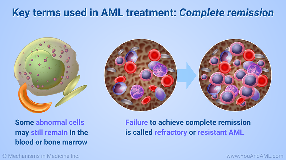 Key terms used in AML treatment: Complete remission