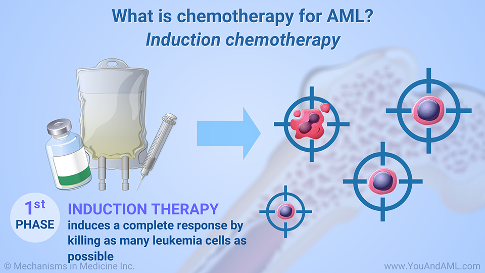 What is chemotherapy for AML? Induction chemotherapy