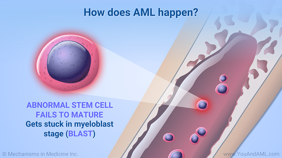 How does AML happen?