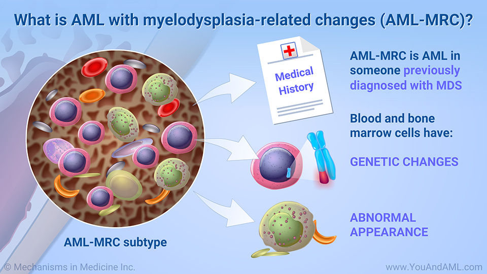 What is AML with myelodysplasia-related changes (AML-MRC)? (Continued)