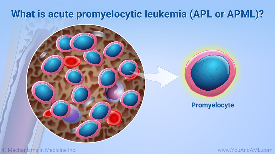 What is acute promyelocytic leukemia (APL or APML)?